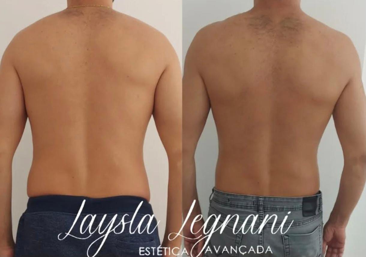 Antes e Depois - Tratamento Corporal